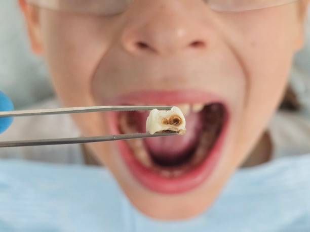 Best Emergency Dentist for Knocked-Out Tooth in Deltona, FL
